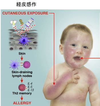 アレルギーの始まり　経皮感作　すずひろクリニック
